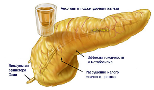 Алкогольный панкреатит