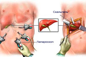 Холецистопанкреатит